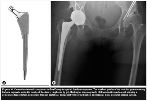 Total hip arthroplasty: Techniques and results.
